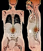 Spinal and pelvic fractures, CT scans