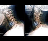 Osteoarthritis of the cervical spine, X-rays