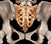 Rear of pelvis and base of spine, 3D CT scan