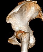 Bones of the hip joint, 3D CT scan