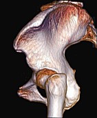 Bones of the hip joint, 3D CT scan