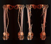 Effects of arteritis in the thigh, 3D CT angiogram