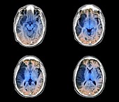 Stroke, MRI brain scans