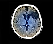 Stroke brain damage, CT scan