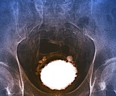 Neurogenic bladder, X-ray