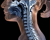 Cervical spine and brainstem, MRI scan