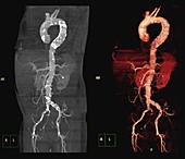 Stent in aortic aneurysm, 3D CT angiograms