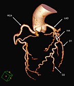 Coronary artery evaluation, 3D CT angiography