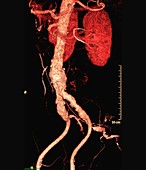 Cholesterol embolism, 3D CT angiogram