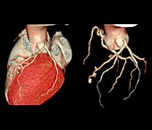 Heart and coronary artery evaluation, 3D CT angiography