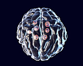 Cryptococcal brain lesions, illustration