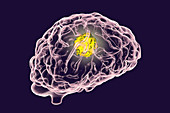 Brain cancer, illustration