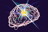 Brain cancer treatment, illustration