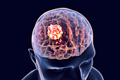 Brain cancer, illustration