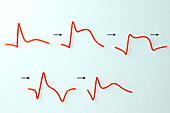 ECG in myocardial infarction, illustration