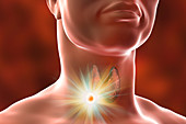 Destruction of thyroid tumour, illustration