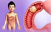 Child with intestinal cancer, illustration