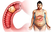 Man with intestinal cancer, illustration