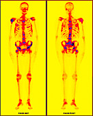 Secondary bone cancer, PET scan