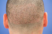 Hair implant treatment