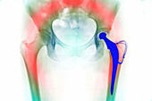 Total hip replacement, X-ray