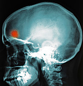 Brain abscess, X-ray