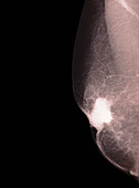 Breast cancer, mammogram