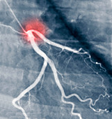 Coronary angiogram