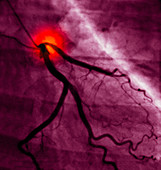 Coronary angiogram
