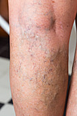 Varicose veins on leg