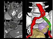 Iliac artery aneurysm, CT scan