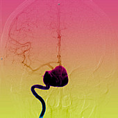 Cerebral aneurysm, angiography