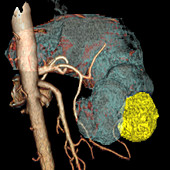 Gastric tumour, CT scan