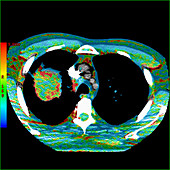 Lung cancer, CT scan