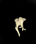 Middle ear, CT scan