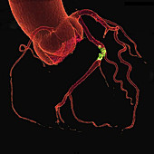 Stenosis of a coronary artery, CT scan