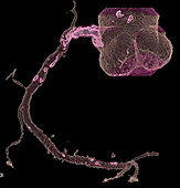 Stenosis of a coronary artery, CT scan