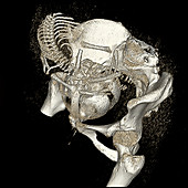 Pelvimetry, CT scan