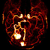 Arteriovenous malformation, CT scan