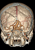Intracranial aneurysm, CT scan