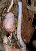 Aneurysm of vertebral artery, CT scan