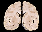 Nipah virus infection, brain specimen