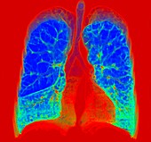 Smoker's lungs and emphysema, illustration