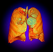 Smoker's lungs and emphysema, illustration