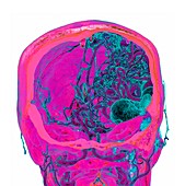 Cerebral arteriovenous malformation, illustration