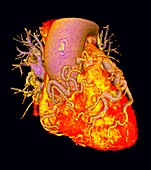 Heart with dilated coronary arteries, illustration