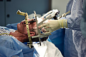 Deep brain stimulation surgery