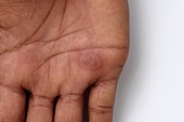 Lesion on hand in fixed drug eruption