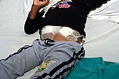 Child being treated with peritoneal dialysis
