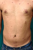 Chickenpox in adult man